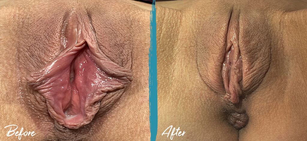 5 weeks post op vy wedge labiaplasty and clitoral hood reduction. pt. desired natural look copy