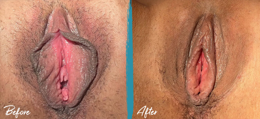 6 weeks post op labiaplasty and vaginoplasty