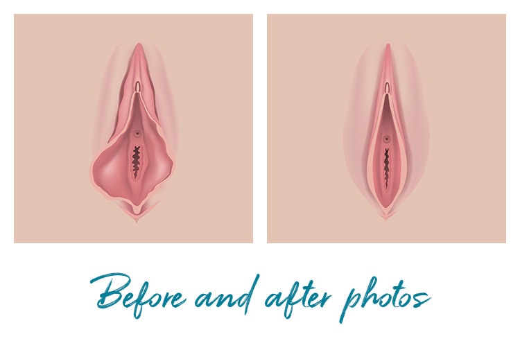 Vaginal Rejuvenation procedures before and after photos California