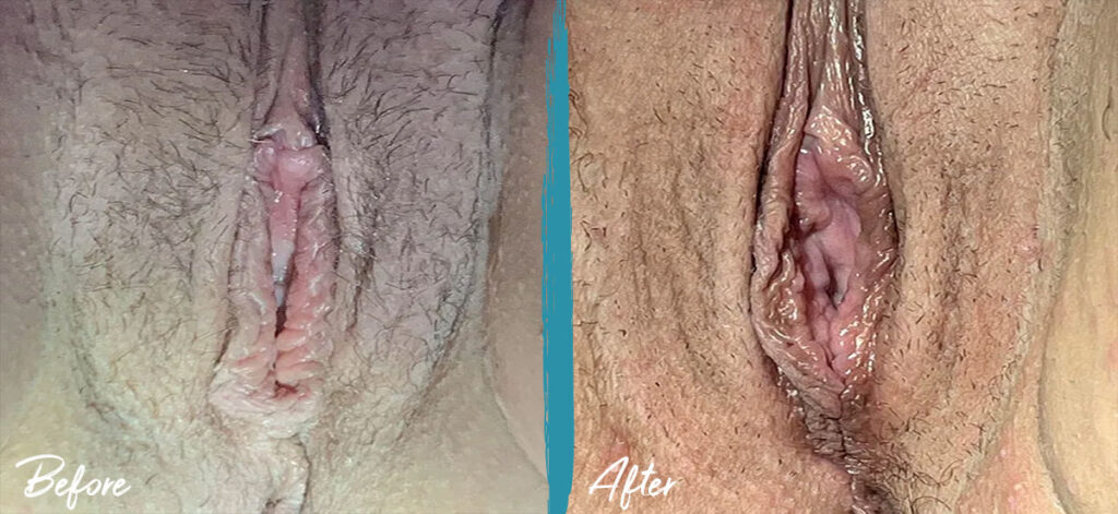 vaginoplasty 6 weeks post op 2